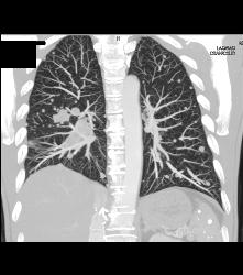 Pulmonary Embolism (PE) and Lung Metastases - CTisus CT Scan