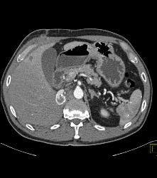 IVC Graft and PE - CTisus CT Scan