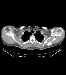 Metastatic Melanoma- See Full Sequence - CTisus CT Scan