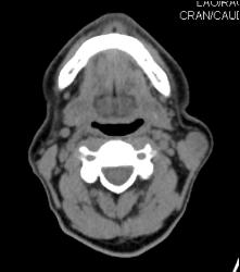 Metastatic Melanoma- See Full Sequence - CTisus CT Scan