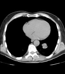 Metastatic Melanoma- See Full Sequence - CTisus CT Scan