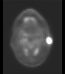 Metastatic Melanoma- See Full Sequence - CTisus CT Scan