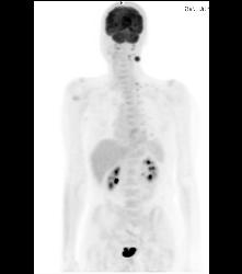 Metastatic Melanoma- See Full Sequence - CTisus CT Scan