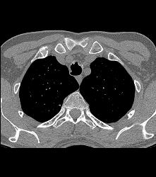 Incredible Case of Tracheopathia Osteochondroplastica - CTisus CT Scan