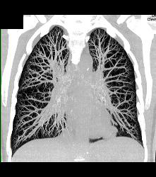 Incredible Case of Tracheopathia Osteochondroplastica- See Full Sequence - CTisus CT Scan