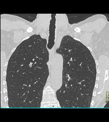 Incredible Case of Tracheopathia Osteochondroplastica- See Full Sequence - CTisus CT Scan