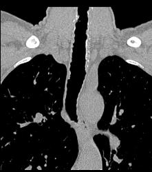 Incredible Case of Tracheopathia Osteochondroplastica- See Full Sequence - CTisus CT Scan