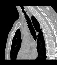 Incredible Case of Tracheopathia Osteochondroplastica- See Full Sequence - CTisus CT Scan