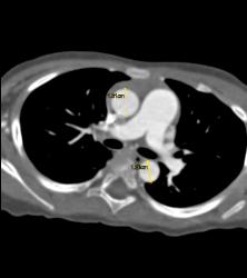 Dilated Aortic Root in Loeys-Dietz Syndrome. Ectatic Carotid Arteries Also Seen - CTisus CT Scan