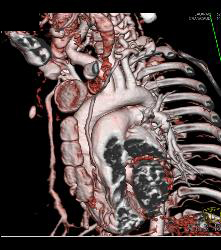 Dilated Aortic Root in Loeys-Dietz Syndrome. Ectatic Carotid Arteries Also Seen - CTisus CT Scan