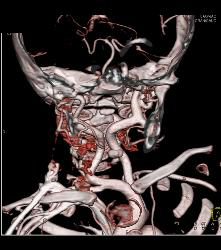 Dilated Aortic Root in Loeys-Dietz Syndrome. Ectatic Carotid Arteries Also Seen - CTisus CT Scan