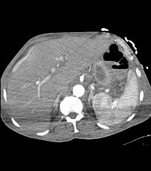 Leaking Aortic Aneurysm With Mediastinal Hematoma- See Full Sequence - CTisus CT Scan