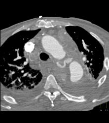 Leaking Aortic Aneurysm With Mediastinal Hematoma- See Full Sequence - CTisus CT Scan