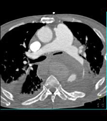 Leaking Aortic Aneurysm With Mediastinal Hematoma- See Full Sequence - CTisus CT Scan