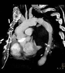 Leaking Aortic Aneurysm With Mediastinal Hematoma- See Full Sequence - CTisus CT Scan