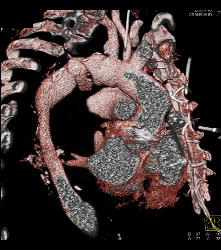 Leaking Aortic Aneurysm With Mediastinal Hematoma- See Full Sequence - CTisus CT Scan