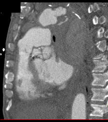 Leaking Aortic Aneurysm With Mediastinal Hematoma- See Full Sequence - CTisus CT Scan