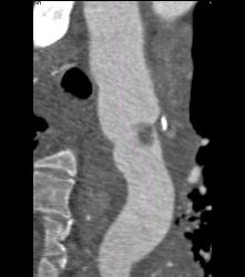 Leaking Aortic Aneurysm With Mediastinal Hematoma- See Full Sequence - CTisus CT Scan