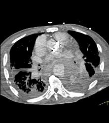 Leaking Aortic Aneurysm With Mediastinal Hematoma- See Full Sequence - CTisus CT Scan