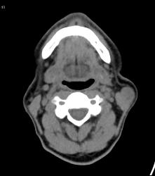 Enlarged Node in Melanoma - CTisus CT Scan