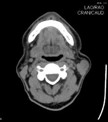 Enlarged Node in Melanoma - CTisus CT Scan