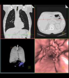 Incredible Case of Tracheopathia Osteochondroplastica - CTisus CT Scan