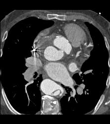 Type A Dissection With Repair of Ascending Aorta and Pseudoaneurysm - CTisus CT Scan