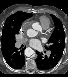 Type A Dissection With Repair of Ascending Aorta and Pseudoaneurysm - CTisus CT Scan