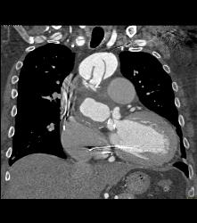 Type A Dissection With Repair of Ascending Aorta and Pseudoaneurysm - CTisus CT Scan