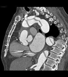 Type A Dissection With Repair of Ascending Aorta and Pseudoaneurysm - CTisus CT Scan