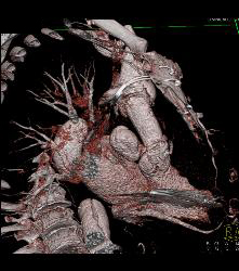 Type A Dissection With Repair of Ascending Aorta and Pseudoaneurysm - CTisus CT Scan