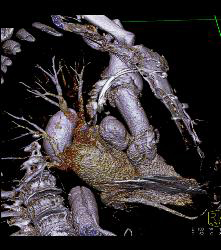 Type A Dissection With Repair of Ascending Aorta and Pseudoaneurysm - CTisus CT Scan