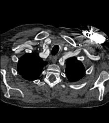 Type A Dissection With Repair of Ascending Aorta and Pseudoaneurysm - CTisus CT Scan