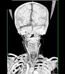 CTA in Loeys-Dietz Patient With Narrowed Abdominal Aorta - CTisus CT Scan