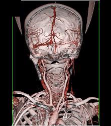 CTA in Loeys-Dietz Patient With Narrowed Abdominal Aorta - CTisus CT Scan