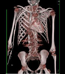 CTA in Loeys-Dietz Patient With Narrowed Abdominal Aorta - CTisus CT Scan