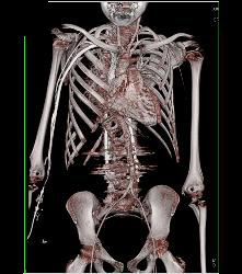 CTA in Loeys-Dietz Patient With Narrowed Abdominal Aorta - CTisus CT Scan