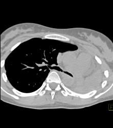 Wegener's Granulomatosis With Narrowed Left Mainstem Bronchus - CTisus CT Scan