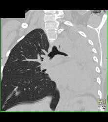 Wegener's Granulomatosis With Narrowed Left Mainstem Bronchus - CTisus CT Scan