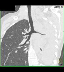 Wegener's Granulomatosis With Narrowed Left Mainstem Bronchus - CTisus CT Scan