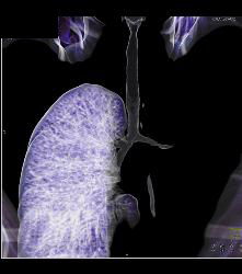 Wegener's Granulomatosis With Narrowed Left Mainstem Bronchus - CTisus CT Scan