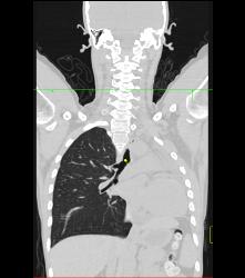 Wegener's Granulomatosis With Narrowed Left Mainstem Bronchus - CTisus CT Scan