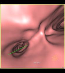 Wegener's Granulomatosis With Narrowed Left Mainstem Bronchus - CTisus CT Scan