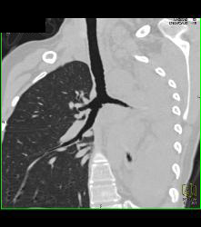 Wegener's Granulomatosis With Narrowed Left Mainstem Bronchus - CTisus CT Scan