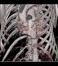 Type B Dissection - CTisus CT Scan