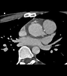 Repaired Aortic Root - CTisus CT Scan