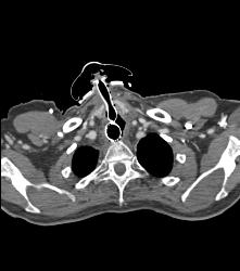 T-e Fistulae With Stent in Trachea and Esophagus- See Full Sequence - CTisus CT Scan