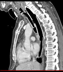 T-e Fistulae With Stent in Trachea and Esophagus- See Full Sequence - CTisus CT Scan