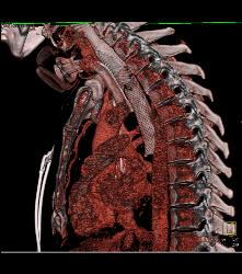 T-e Fistulae With Stent in Trachea and Esophagus- See Full Sequence - CTisus CT Scan