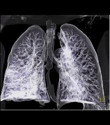 T-e Fistulae With Stent in Trachea and Esophagus- See Full Sequence - CTisus CT Scan